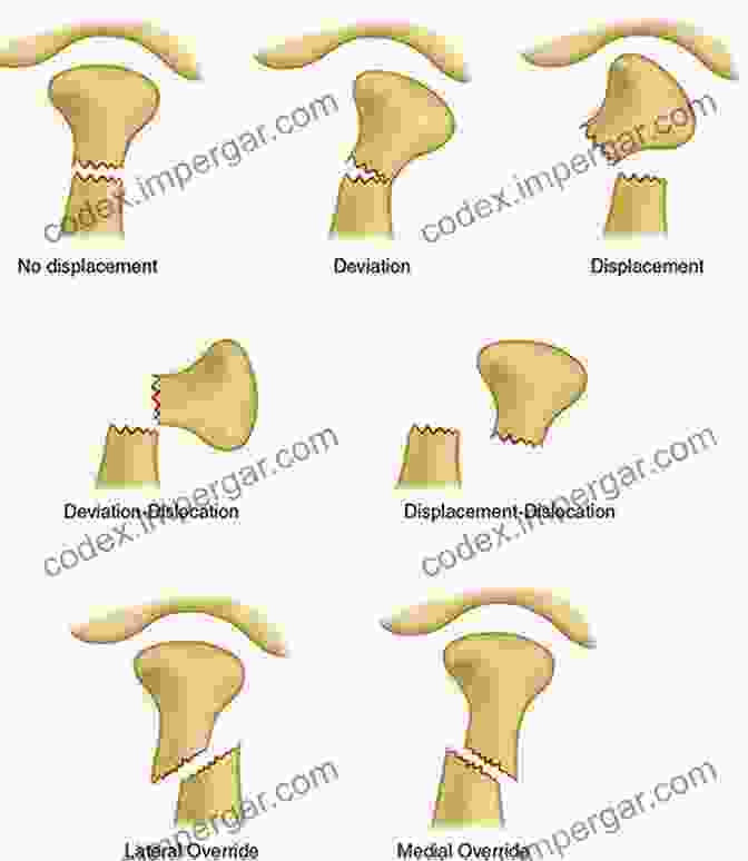 A Close Up Image Of A Mandibular Condylar Fracture, Showcasing The Intricate Anatomy Of The Region. Advances In The Management Of Mandibular Condylar Fractures An Issue Of Atlas Of The Oral Maxillofacial Surgery (The Clinics: Surgery 25)