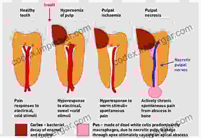 Diagram Of Dental Caries Progression A Simple Guide To Dental Caries Treatment And Related Diseases (A Simple Guide To Medical Conditions)